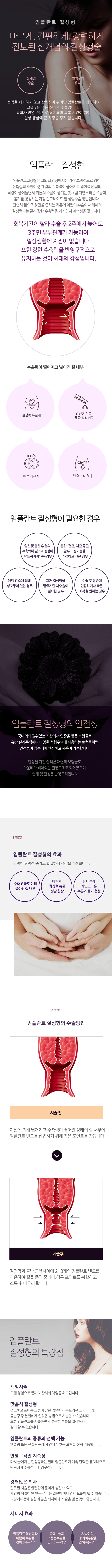 임플란트 질성형